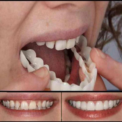 facetas dentárias Natural Removível (Superior e Inferior)